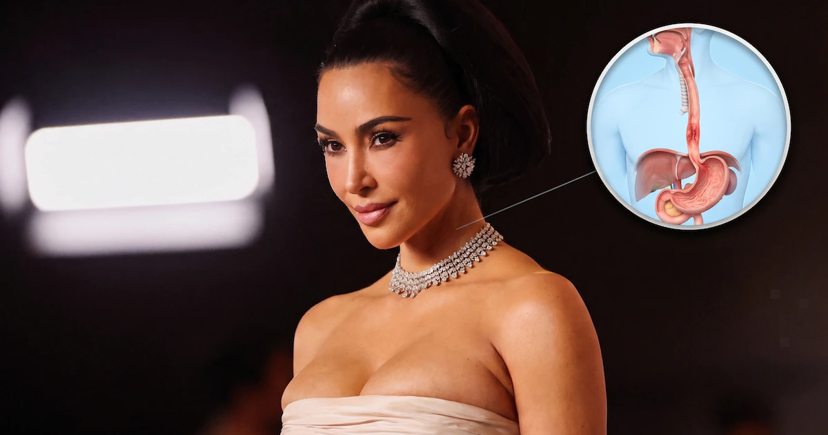 Qué es la esofagitis, la afección que llevó a Kim Kardashian a una intervención