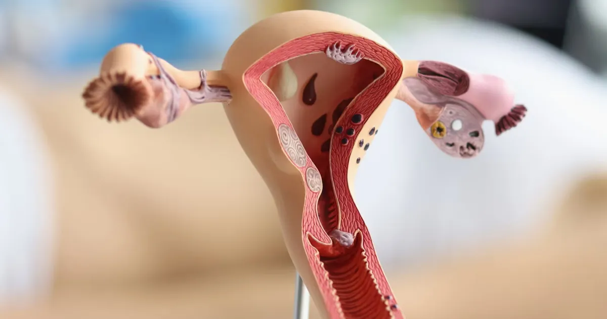 Endometriosis: cuando controlar las hormonas no basta para frenar el dolor